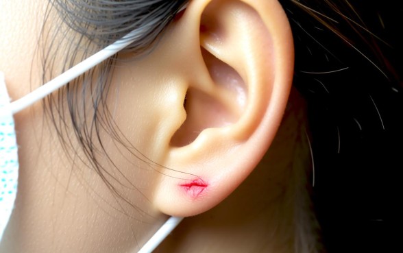 耳垂下方长了一道口子是什么引起的