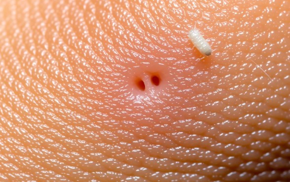 什么虫子白色的咬一下有两个口子,被虫子咬了怎么办 什么虫子白色的咬一下有两个口子