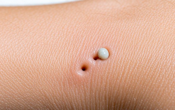 什么虫子白色的咬一下有两个口子,被虫子咬了怎么办 什么虫子白色的咬一下有两个口子